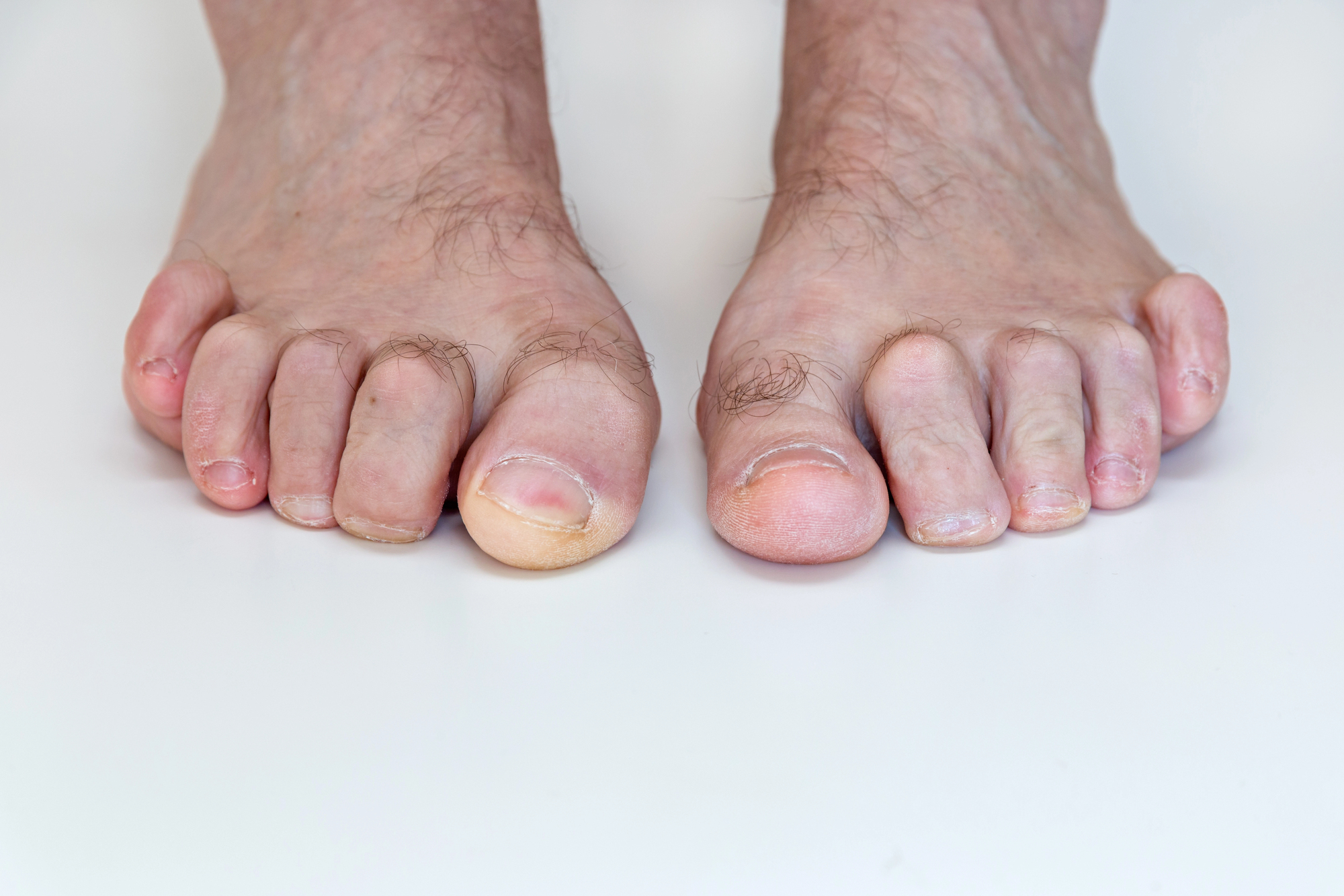 אצבע פטיש (Hammer Toe)